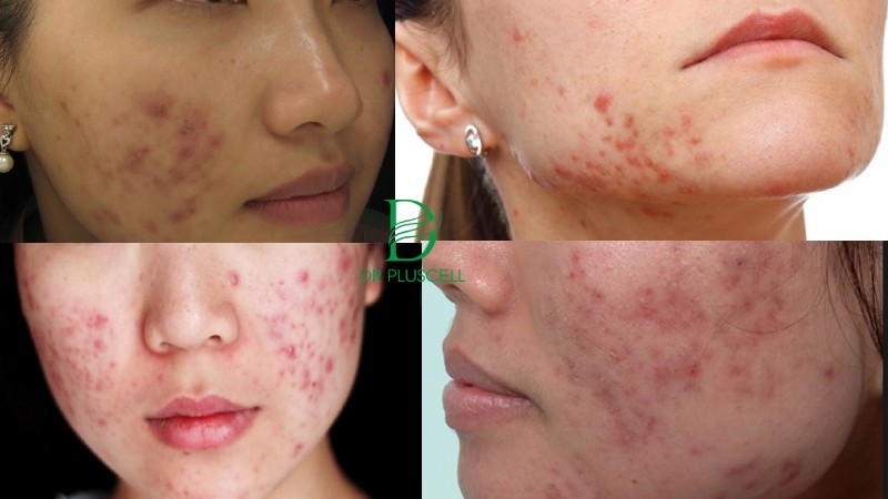 Tác hại của vi kim tảo biển - Mặt trái mà bạn cần biết