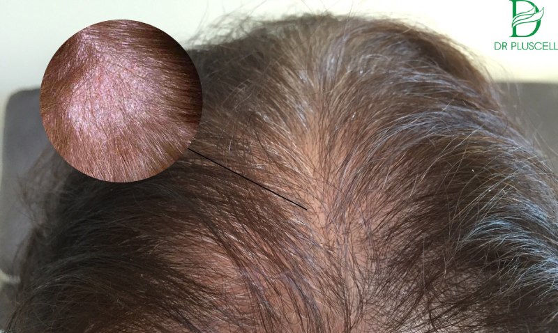 Nấm da đầu gây ra các mảng tóc bị rụng, lộ da trần trụi