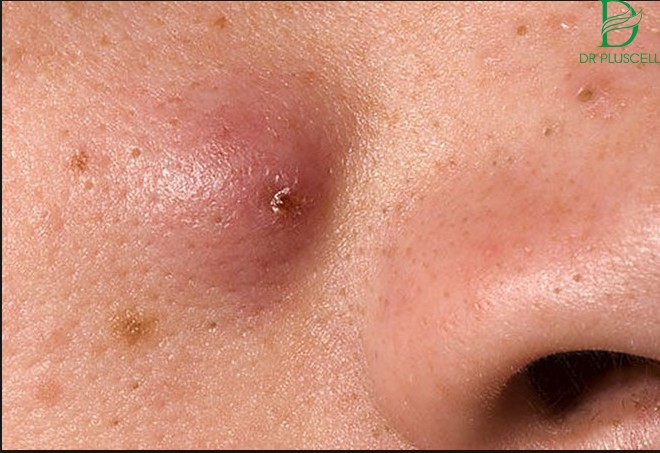 Nặn mụn đầu đen ở mũi dễ gây biến chứng