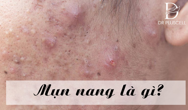 Mụn nang là gì? Nguyên nhân và cách điều trị tự nhiên ngay tại nhà